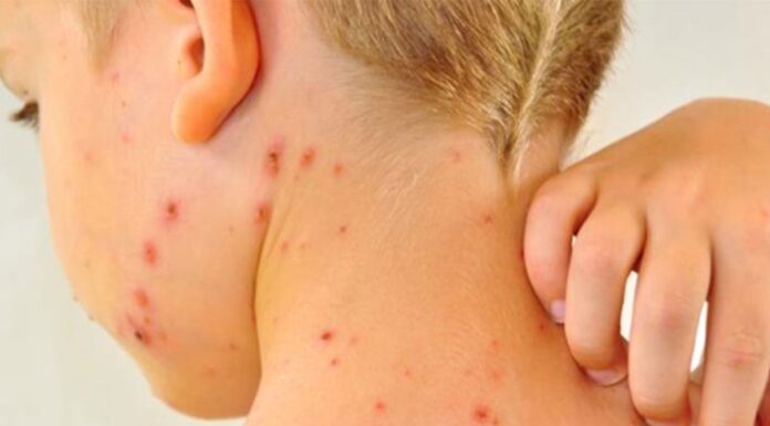 Salud recomienda vacunarse contra el sarampión antes de viajar