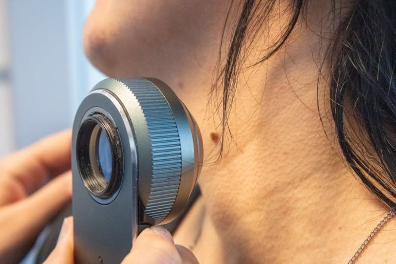 Campaña de control de lunares y detección temprana de Cáncer de piel